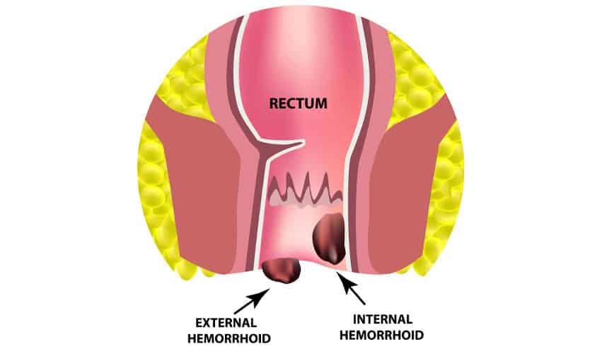 treating-hemorrhoids-permanently-at-home