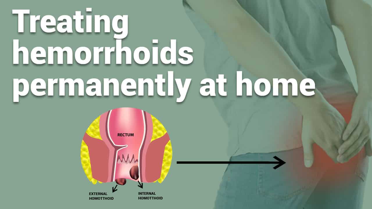 treating-hemorrhoids-permanently-at-home
